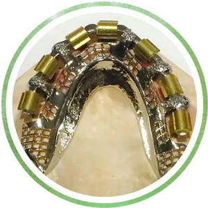 Attachments and Implants Chrome Cast Dental Laboratory