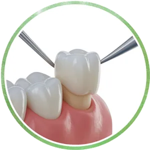 Zirconia Crowns Chrome Cast Dental Laboratory